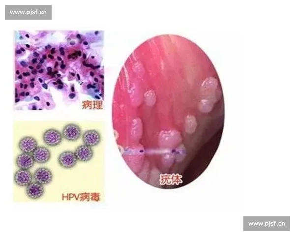 深入解析尖锐湿疣的传播机制防治策略及心理干预新进展